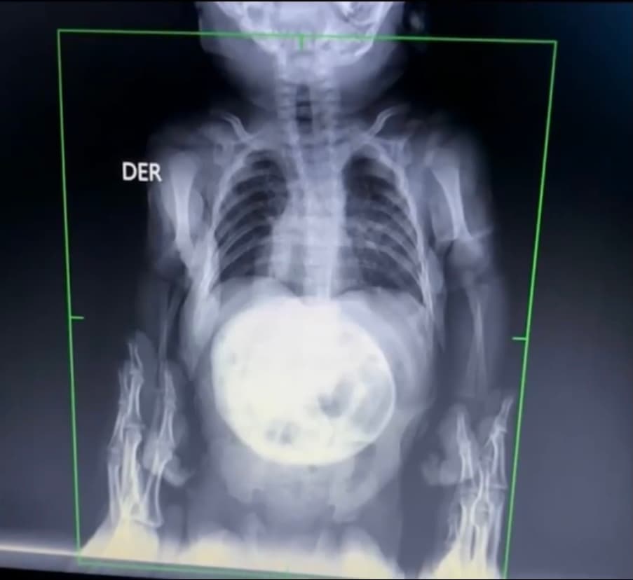 Si bien la bebé ha logrado ir en contra de todos los pronósticos de los doctores, ahora su familia necesita con urgencia poder someterla a una cirugía
<b>-que no se puede aplicar en su natal <a href="https://www.univision.com/temas/guatemala">Guatemala</a>- </b>para que corrija de una vez por todas esta malformación.
<br>