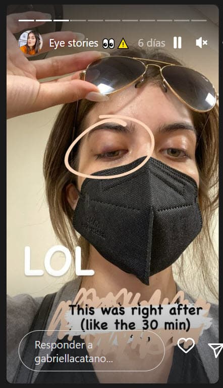 "Luego ingresan con varias inyecciones de lidocaína en el interior del párpado y la parte superior del párpado (donde sea que se encuentre el chalazión), 
<b>estos realmente no duelen</b>, porque ya el ojo está un poco dormido por las gotas", escribió.
<br>