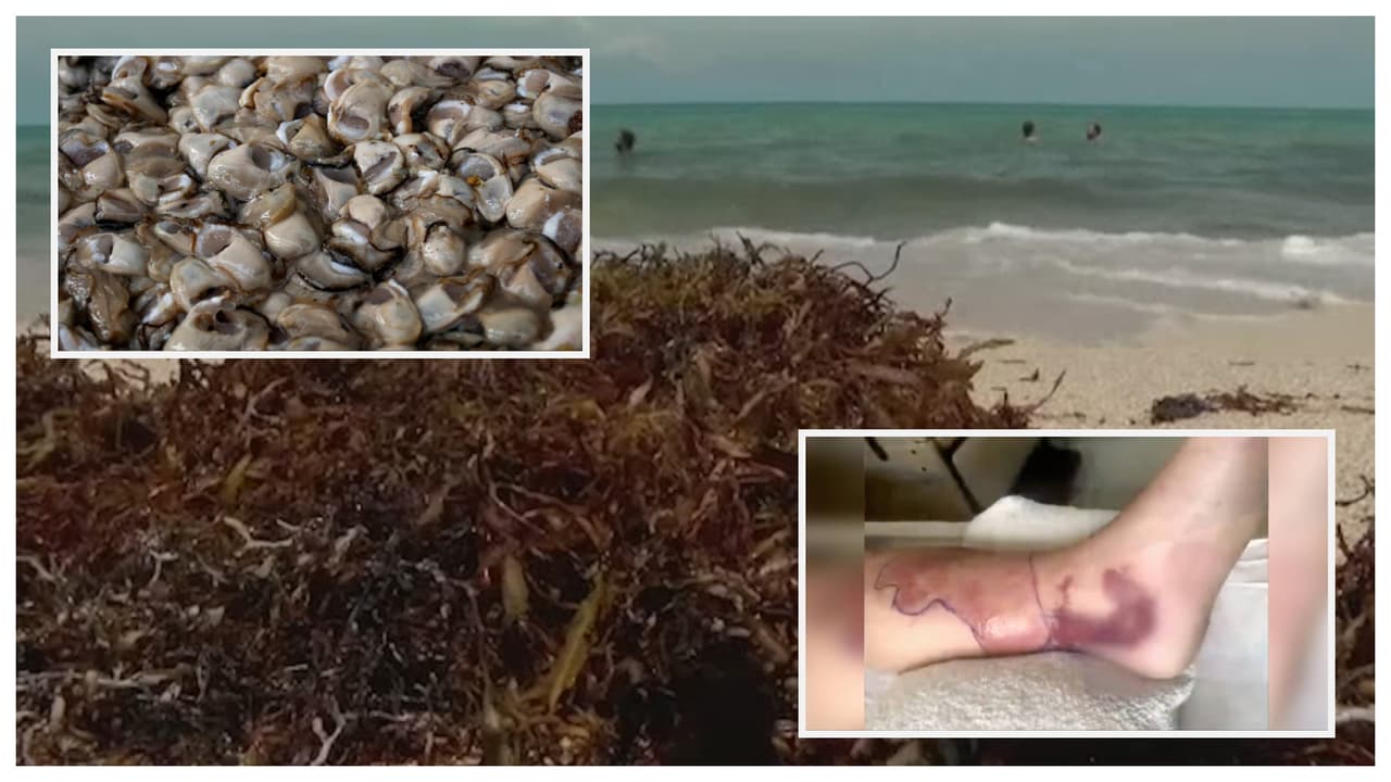 Alerta por bacteria come carne en Florida: cuáles son los síntomas y cómo prevenir infectarte 