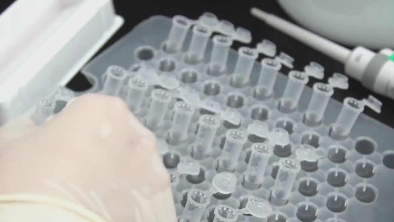 Mielitis transversa: el trastorno en un voluntario que hizo detener la fase 3 de la vacuna de AstraZeneca