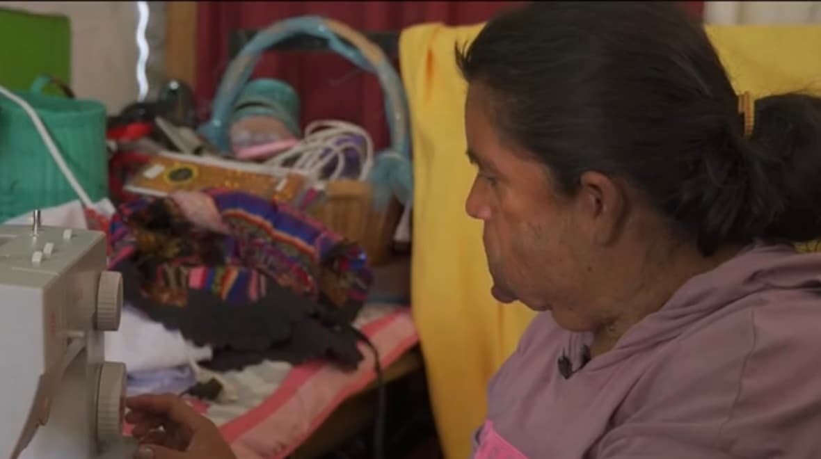 La pobreza en la que Hernández está inmersa no le permitió nunca acceder a un tratamiento médico,
<b> pero sí a un diagnóstico que arrojó un hemangioma</b>, es decir una formación externa de vasos sanguíneos, aunada a una deformación en su rostro. 
<br>