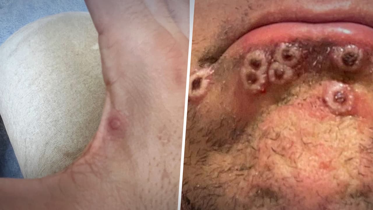 Aunque se ha dicho que los niños no están en riesgo de contraer la viruela del mono, existe la duda de: "¿qué podría pasar con los adolescentes?". Un especialista considera que la mejor prevención con los menores es fomentar la educación.