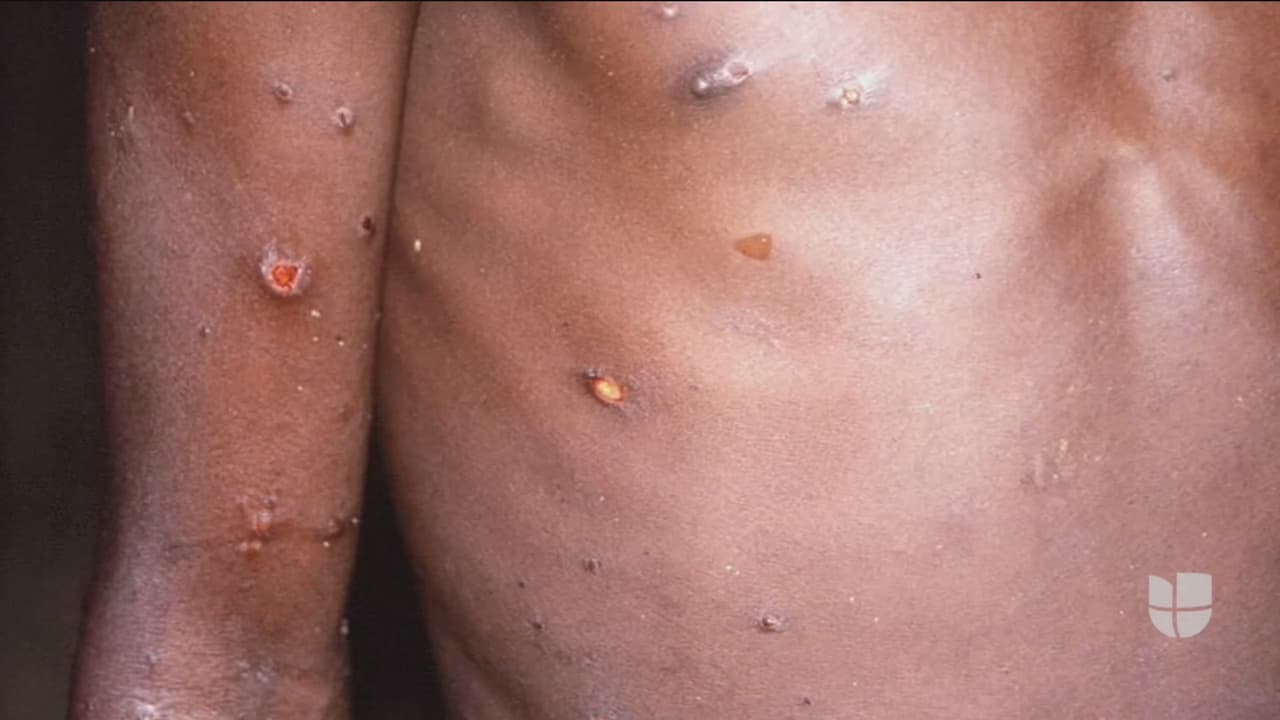 Investigan posible caso de viruela del mono en Los Ángeles