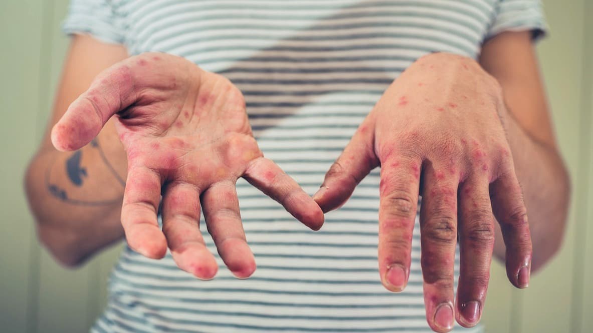 Reportan dos nuevos casos de sarampión en West Los Ángeles