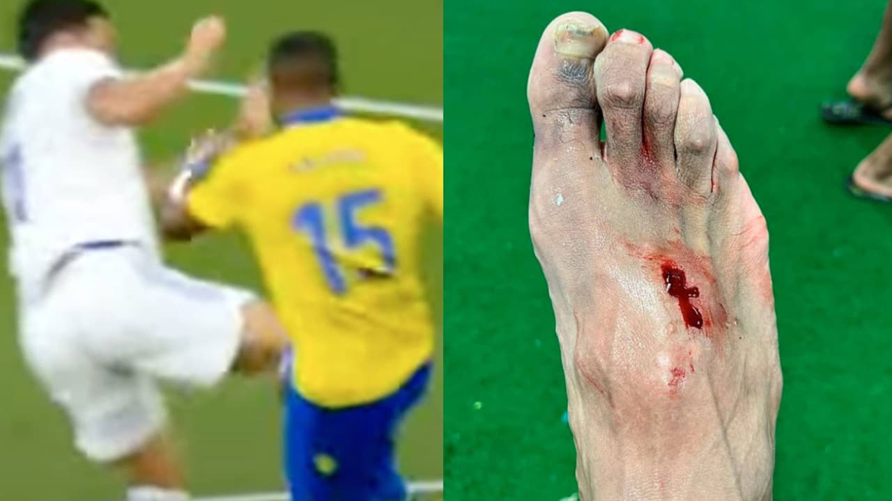 Carlos Akapo muestra la fuerte herida en su pie tras entrada de Eden Hazard