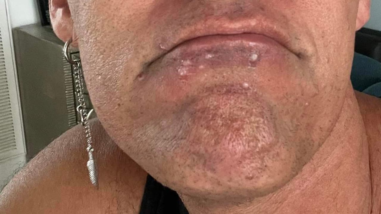 “El lunes noté que me comenzaron a salir como pequeñas ampollas y pensé: 'oh esto se ve mal, como erupciones en la cara' y para el martes me di cuenta de que no era normal y que era algo más”, cuenta Wesley Wallace.