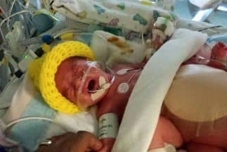 Nacen trillizas idénticas en Texas; dos de ellas son siamesas