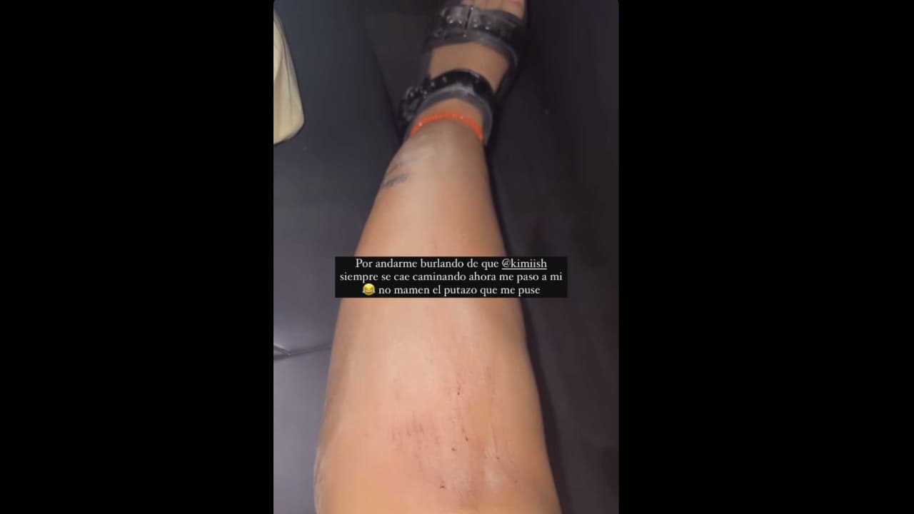 Romina Marcos, hija de Niurka, mostró el golpe que sufrió tras fuerte caída