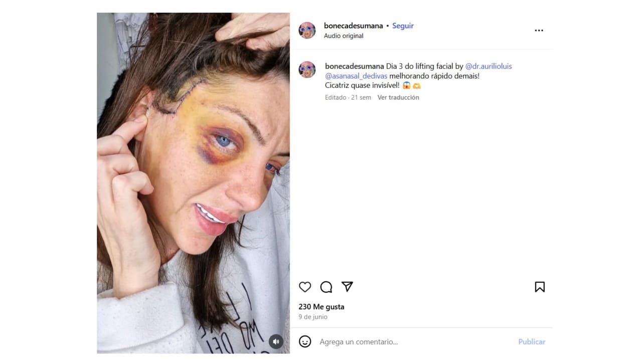 Así documentaba su recuperación de su última cirugía.