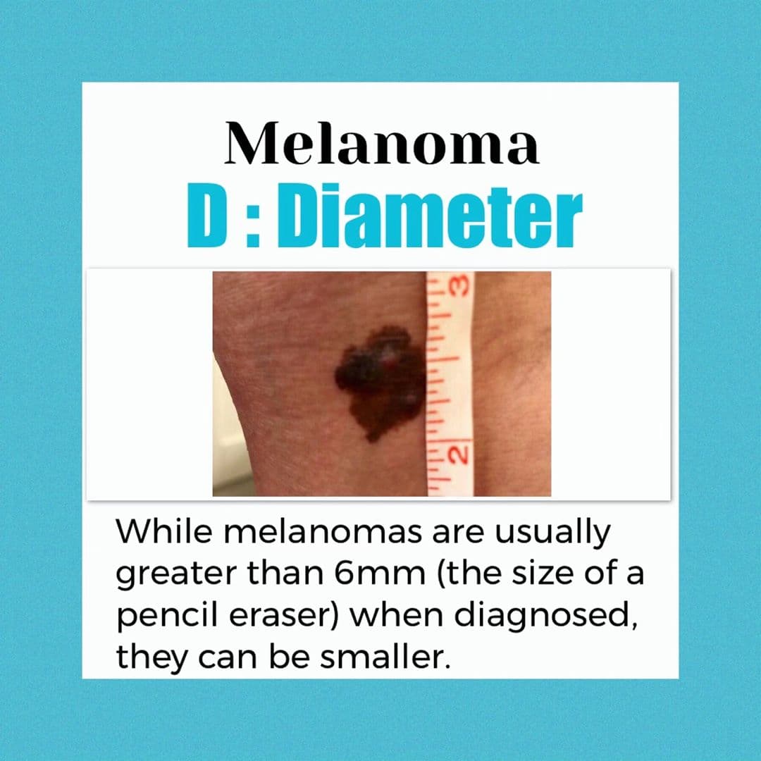 Además, aprovecha para compartir con sus seguidores cómo detectar las señales del melanoma y prevenir la enfermedad.