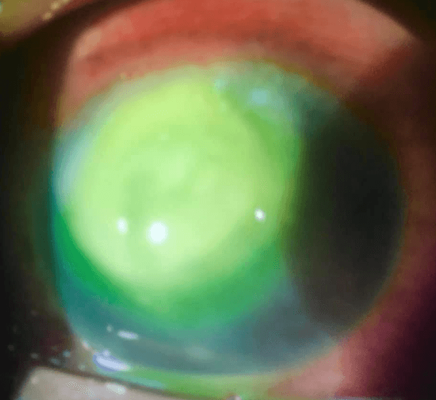 Uno de los pacientes de Vollmer padece de una úlcera por la bacteria pseudomonas al usar los lentes en las horas de sueño.