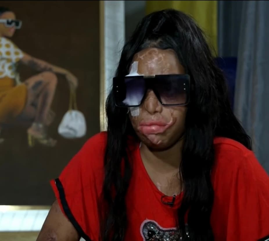 “No vi quien era porque me lo tiraron a los ojos; fue demasiado tarde”, recuerda Yocayri, quien perdió el ojo derecho, gran visibilidad del otro, se quedó con el 40% de su cuerpo quemado 
<b>y necesitó unas 11 <a href="https://www.univision.com/temas/cirugia">cirugías</a> para tratar de reconstruir su rostro.</b>
<br>