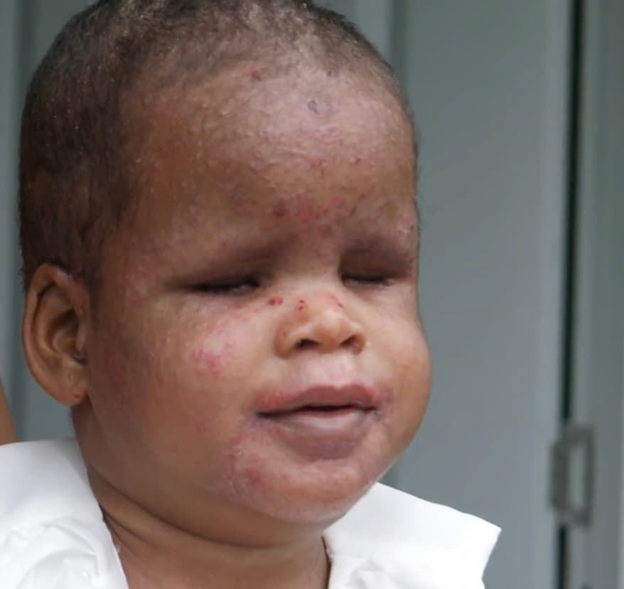 Lejos de tener al alcance un tratamiento, los altos costos de las curaciones y procedimientos quirúrgicos que necesita la pequeña, han asfixiado a la familia, luego de que los mismos genetistas en Alemania explicaran que la menor tenía una dermatitis atópica severa en su piel seca.
<br>