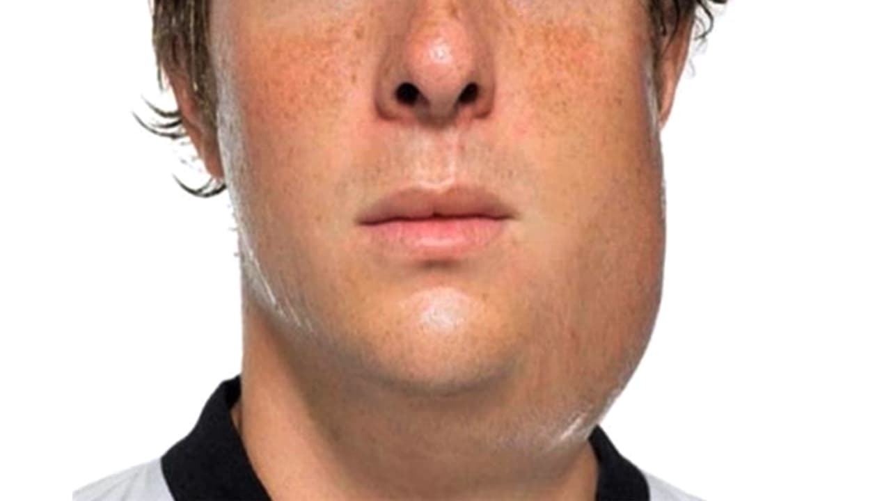 Sube a 8 el número de casos de paperas en Las Carolinas