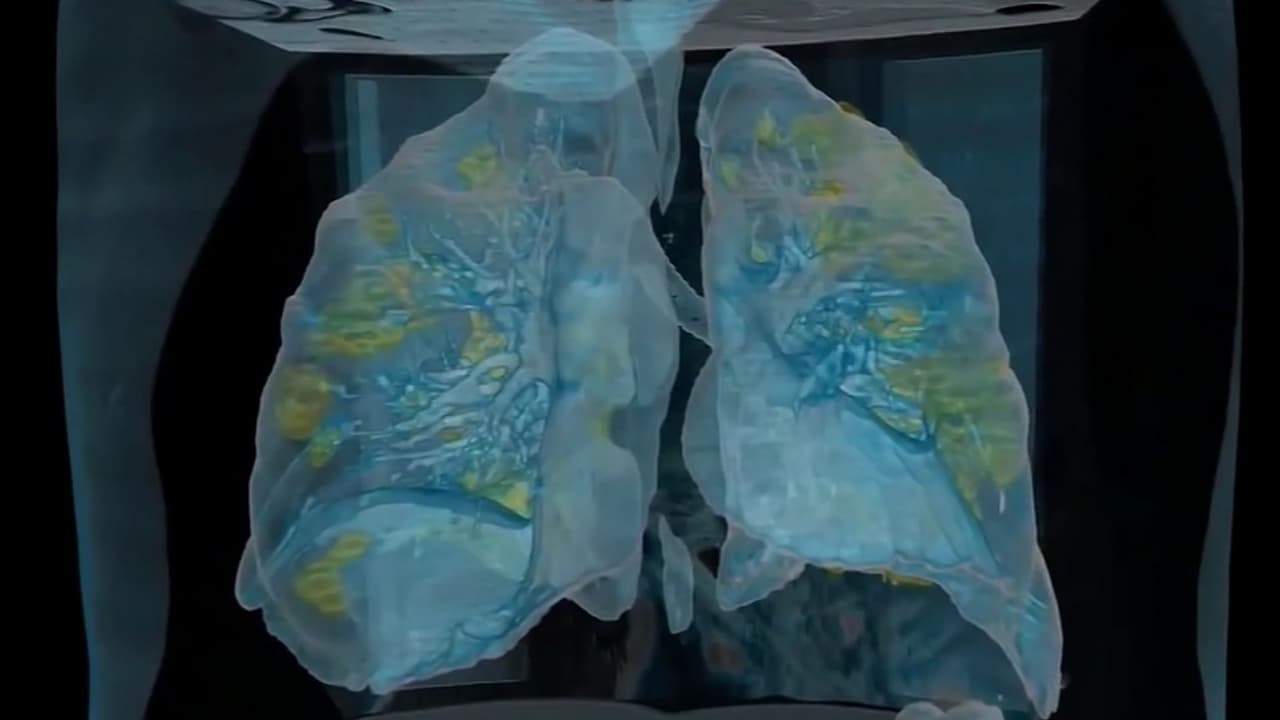 Jóvenes no fumadores con cáncer de pulmón: estudio revela posible causa