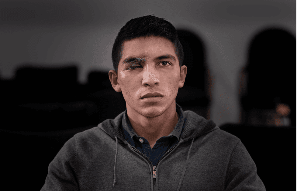 Dilan Yesid Suárez, de 21 años, residente de Bogotá, dice que la policía nacional de Colombia apuntó deliberadamente a su ojo con balas de goma no letales durante las protestas en junio que recorrieron Colombia.
<br>