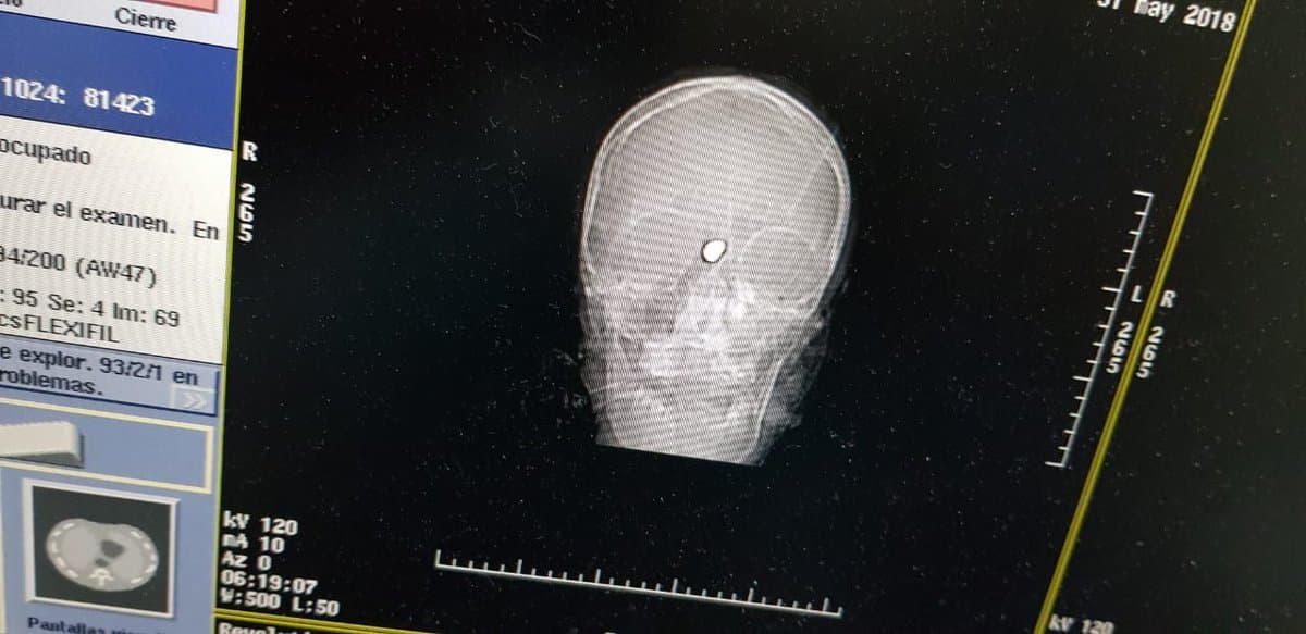 These X-rays are of a victim who died in a protest against the government of Daniel Ortega. It shows a single gunshot to the head.