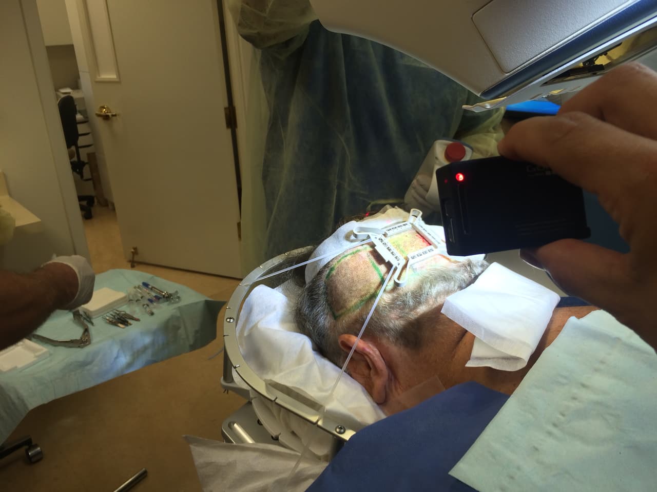 El Gordo se injertó cabello y nos mostró todo el proceso.