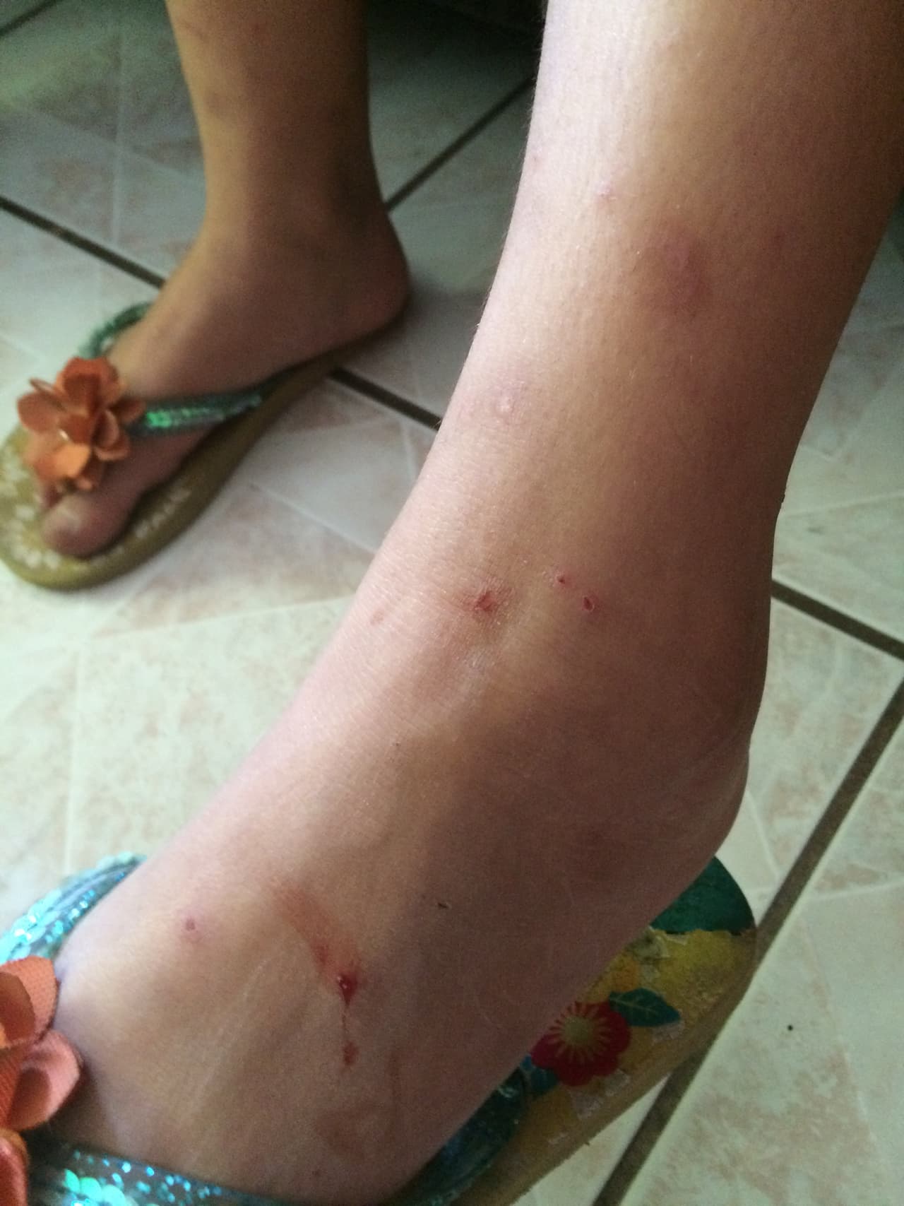 La familia Salcido está tratando las irritaciones con crema con cortisona.