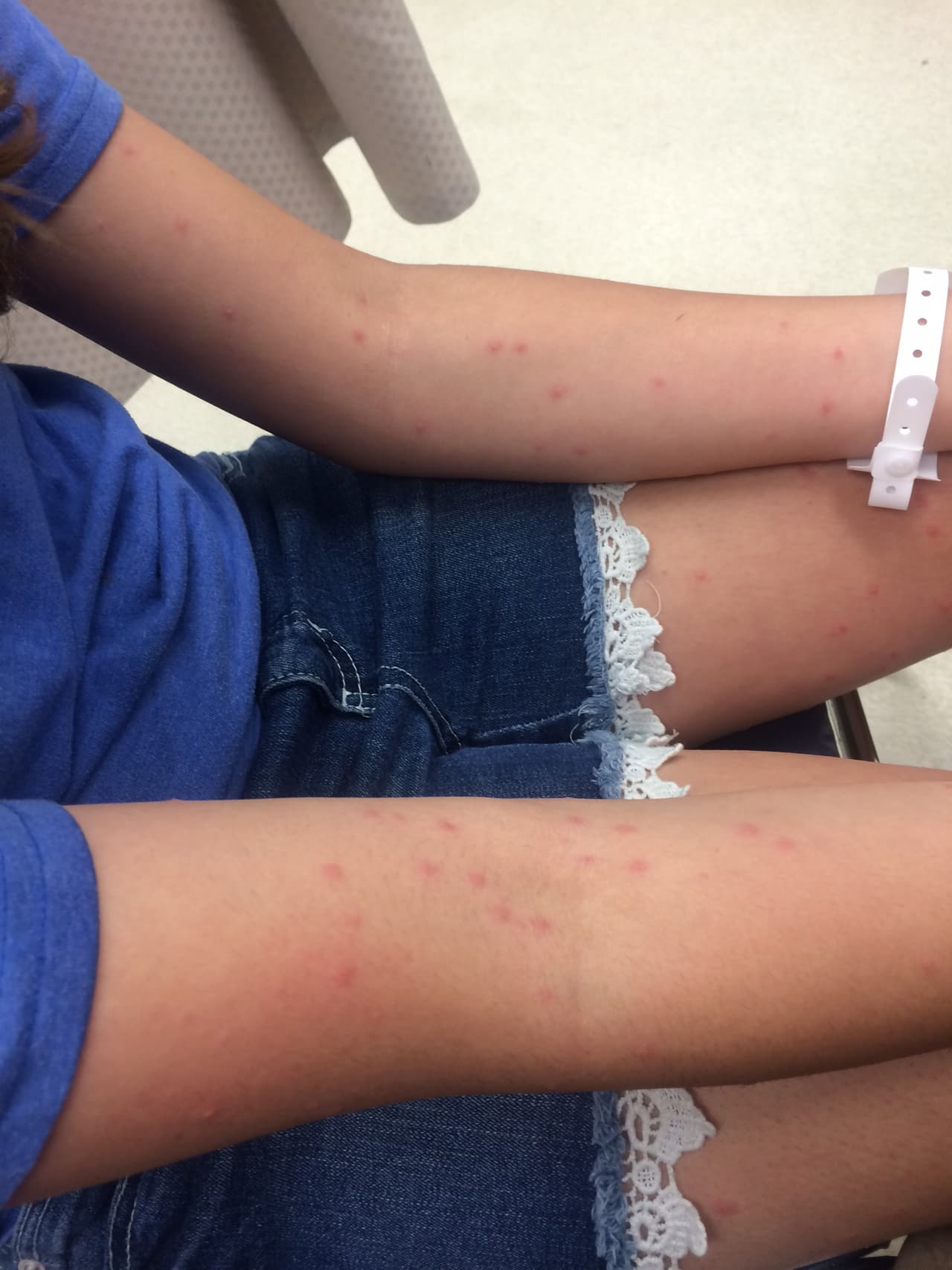 Esta niña presenta irritación y picores en brazos y piernas.