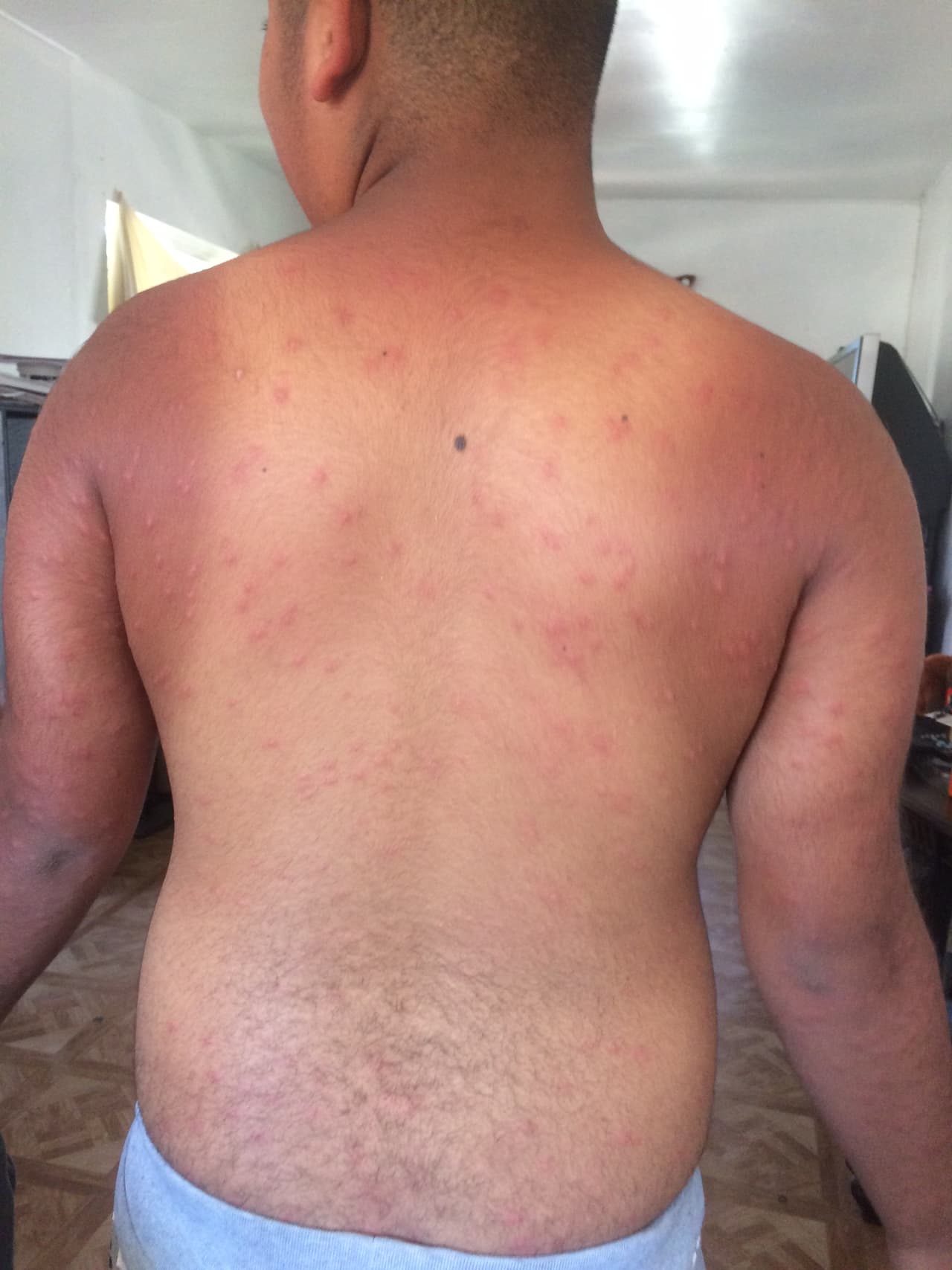 Erupciones cutáneas en toda la espada y brazos por la exposición al tóxico del agua del lago Pyramid.