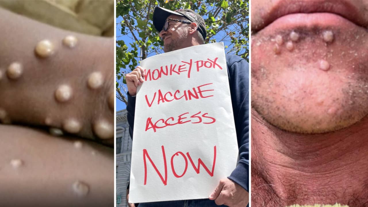 En California, los casos de a viruela del mono reportados y confirmados llegan a 780. Entre los condados de Los Ángeles y San Francisco, los casos superan los 500 y las autoridades sanitarias podrían declarar una emergencia sanitaria estatal en las próximas semanas.