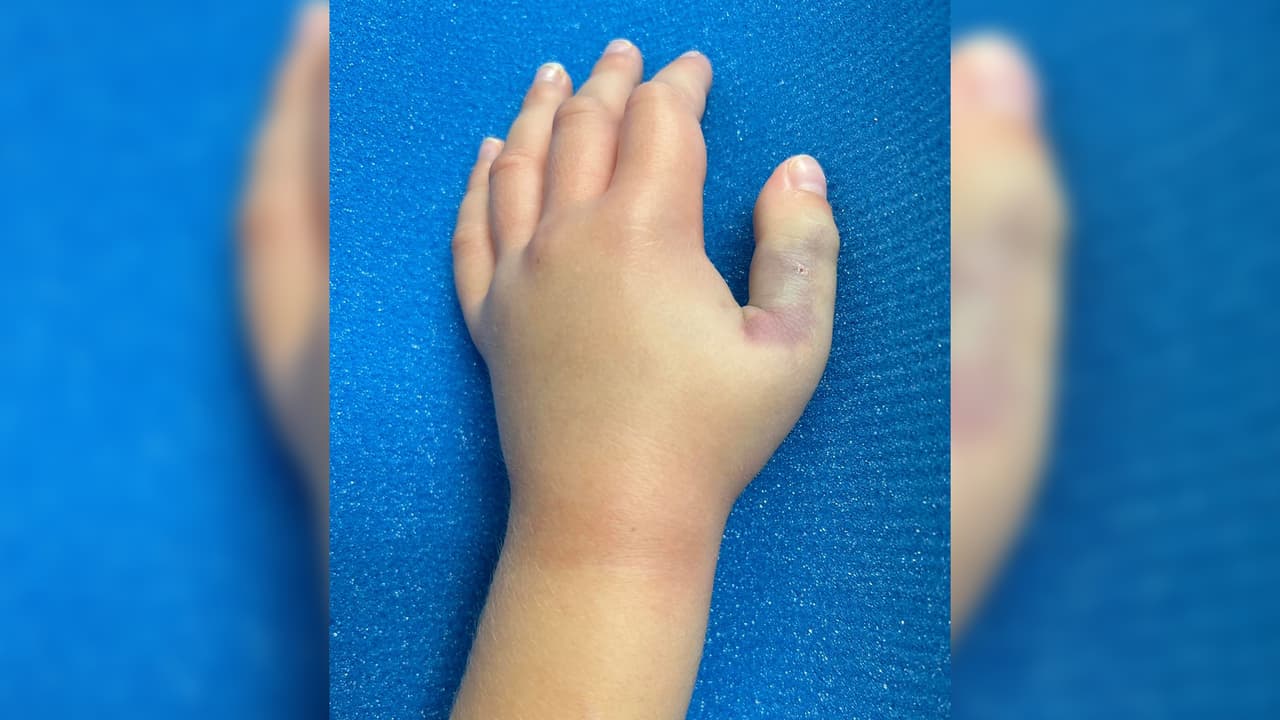 “Ahora miro hacia atrás y veo cuán bendecidos fuimos porque las cosas encajaron. Fue una serpiente bebé la que lo mordió con su colmillo en el pulgar. El doctor Greene estaba ese día en turno y en menos de 30 minutos lo atendió”, continuó la mujer.