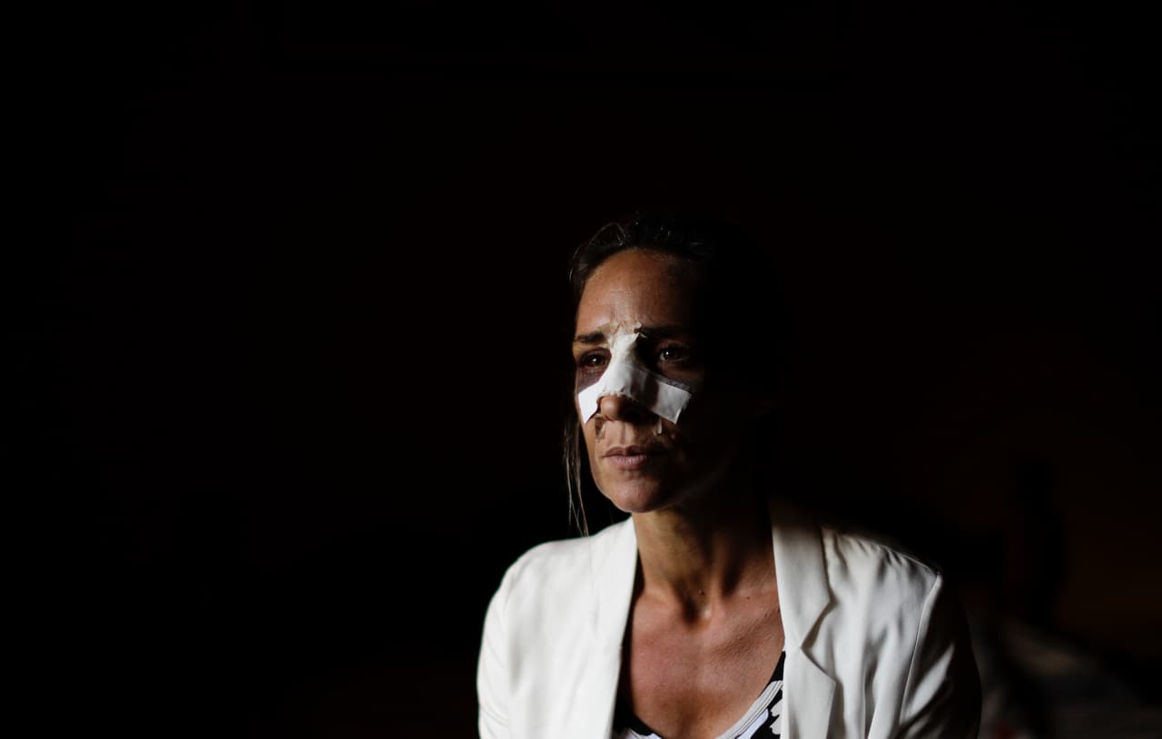 Paola Mascambruni fue golpeada por su compañero, el padre de uno de sus hijos. Tuvo fractura de cráneo, trauma nasal, varios dientes rotos, el cuello severamente magullado y hematomas en todo su cuerpo. La foto fue tomada en su casa en Buenos Aires, cinco días después de la agresión, el 21 de marzo de 2017.