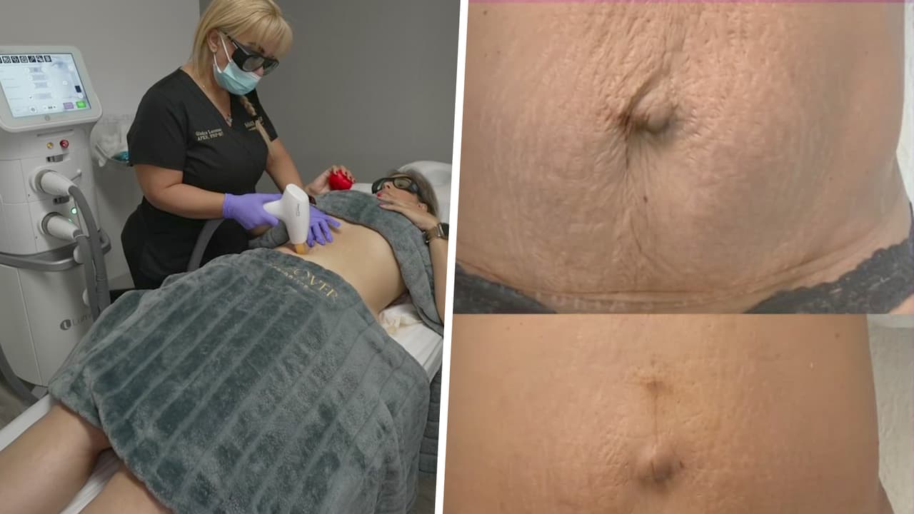 'Laser Skin Resurfacing' es el tratamiento perfecto para eliminar estrías y cicatrices