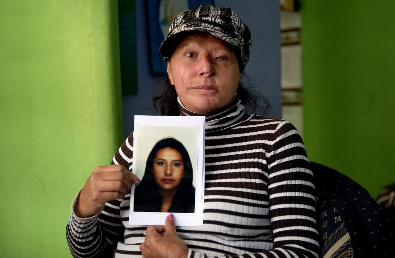 Maria Cuervo es otra de las víctimas de este tipo de ataques. Le arrojaron ácido sobre el rostro el 8 de marzo de 2004.