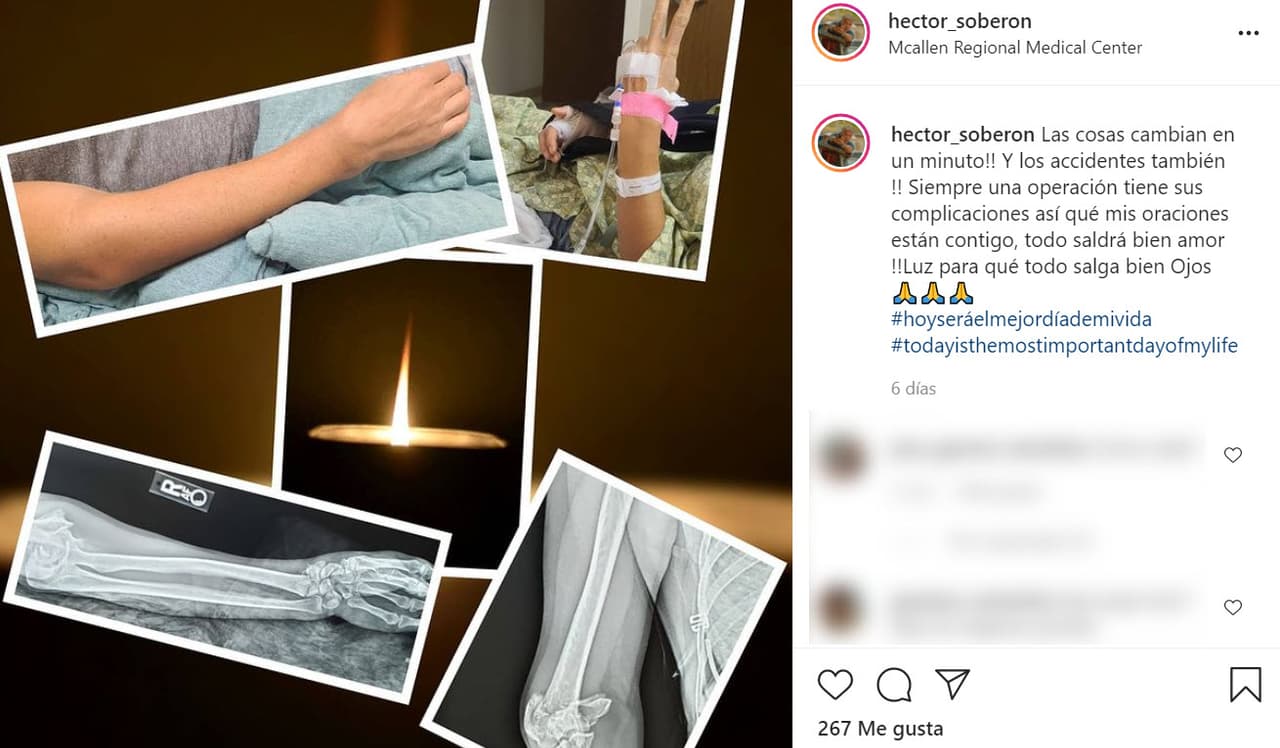 "Cuando entré en la sala de espera, 
<b><a href="https://www.instagram.com/p/CRANYq8jy6i/" target="_blank">el brazo (lo tenía) totalmente hinchado</a></b> y lo veía raro", continuó y confirmó que tuvo que ser sometida a una cirugía. 
<br>