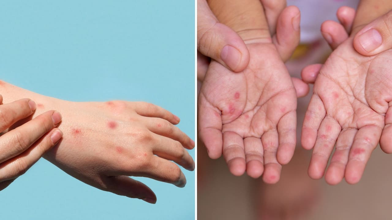 Autoridades de salud de Nueva Jersey reportan tres casos de sarampión detectados en febrero