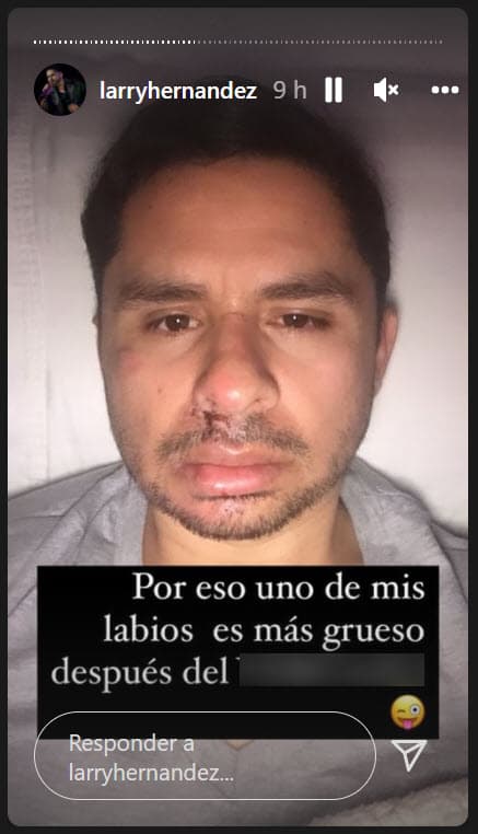 En enero de 2018, cuando se cumplió un mes del percance, el cantante admitió en Instagram que la vida le cambió tras lo sucedido. 
<br>