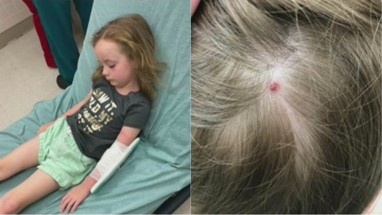 Una niña de 5 años sufrió una misteriosa parálisis, su madre le revisó el cuero cabelludo y descubrió de qué se trataba