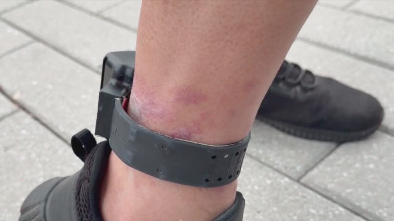Inmigrante hispano pide retiro de grillete electrónico por infección; teme perder el pie