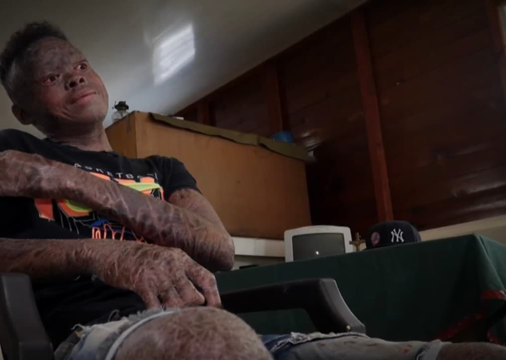 A pesar de vivir en la alejada comunidad dominicana de Malverde Mao en un ambiente empobrecido, Tejada se ha dedicado en cuerpo y alma a cuidar a su hijo, quien ahora con 17 años, no recuerda un solo día sin dolor ni humillaciones, al ser conocido en la localidad como ‘el joven piel de pescado’.
<br>