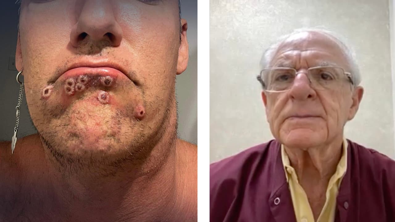 “La recomendación de la comunidad médica para aquellas personas que ya tuvieron la viruela del mono es que 
<b>ya no se deben de vacunar porque la enfermedad les va a dar una inmunidad permanente”,</b> dijo el Dr. Martín Yudovich, reconocido médico del área de Houston.