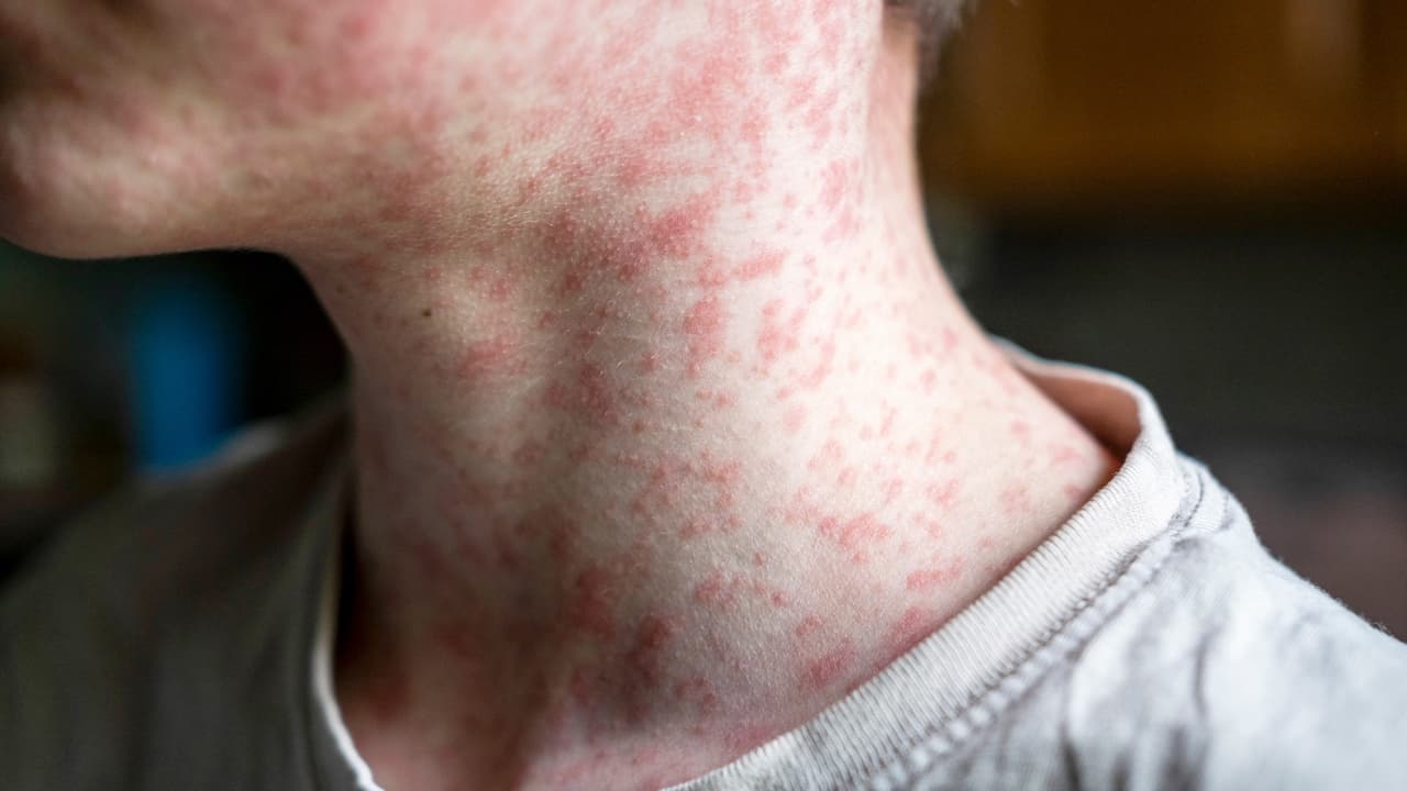 Sarampión en California: Situación actual, síntomas y cómo prevenirlo