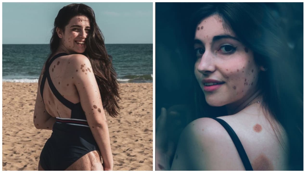 Se burlaban de ella por tener mil lunares y manchas en el cuerpo: ahora es una gran modelo