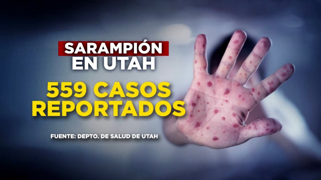 Sarampión en Utah, se registran al menos 559 contagios confirmados