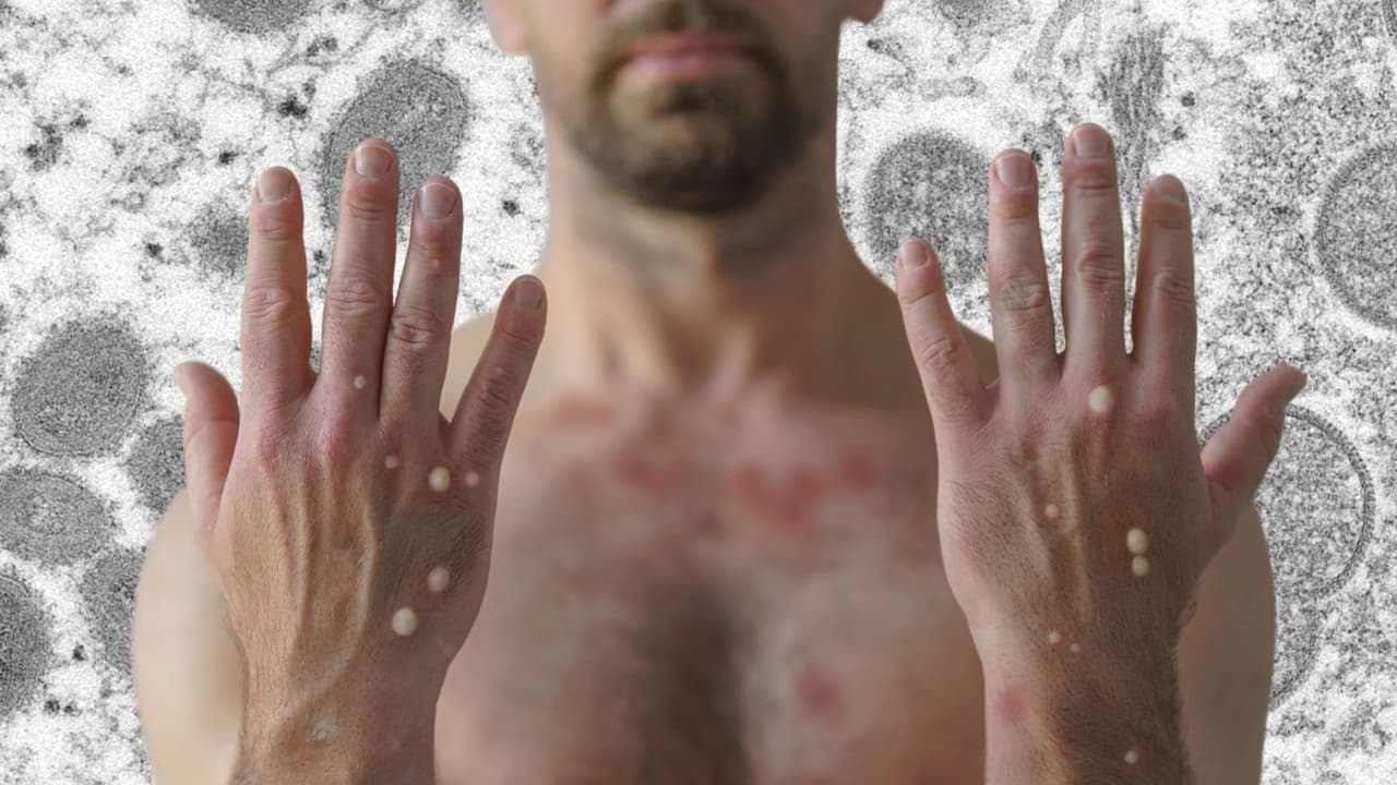 Viruela del Mono: reportan segundo caso probable en el condado de Santa Cruz