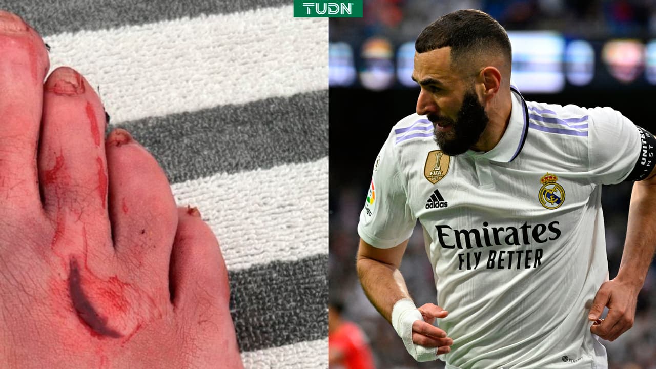 Karim Benzema juega lesionado ante Rayo desde el minuto 10 y recibe puntos de sutura