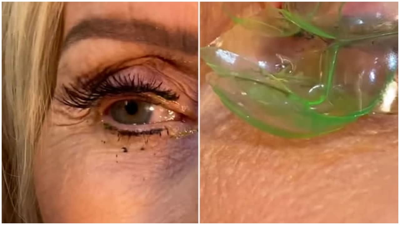 Doctora remueve 23 lentes de contacto escondidos en el ojo de una paciente