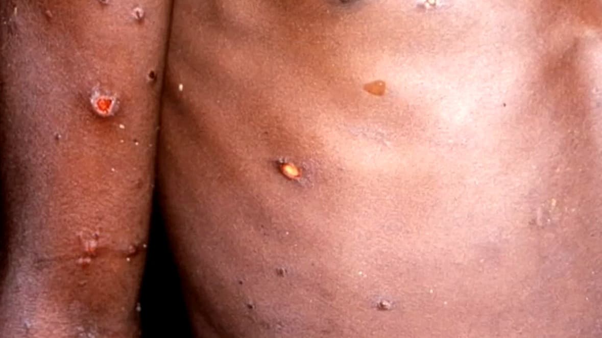 Viruela del mono: recomendaciones del Dr. Juan para evitar un contagio