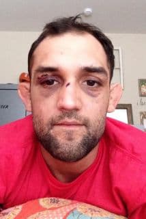 Johny Hendricks sube una foto con las lesiones de su rostro tras UFC 171