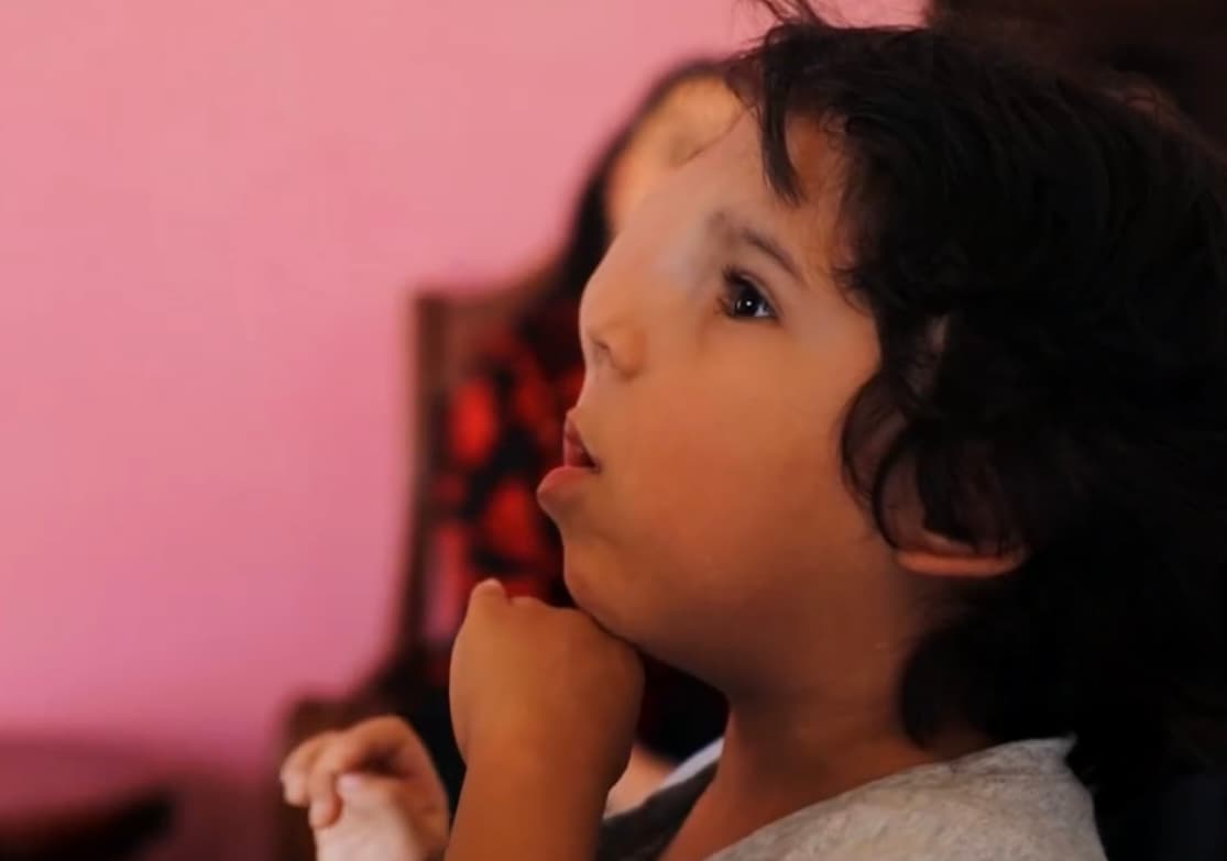 Desde que nació, el pequeño venezolano Lucas Thielen ha sufrido el rechazo de otras personas 
<b>por la malformación en su cráneo y rostro que padece. </b>
<br>