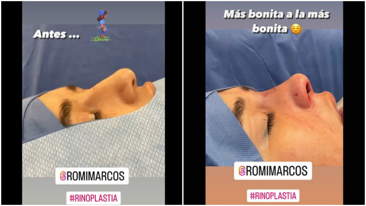 A través de varias historias, la cantante de 26 años ha compartido imágenes del 
<b>antes y después</b> de la rinoplastia.
<br>