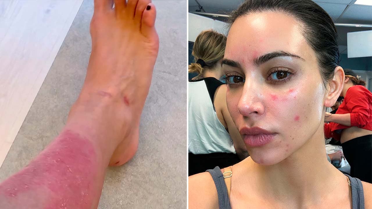 Kim Kardashian lucha desesperada contra su propia piel: sus remedios podrían afectarla más