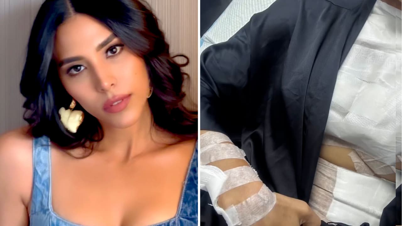 Miss República Dominicana sufre quemaduras tras explosión de olla de presión: imágenes 