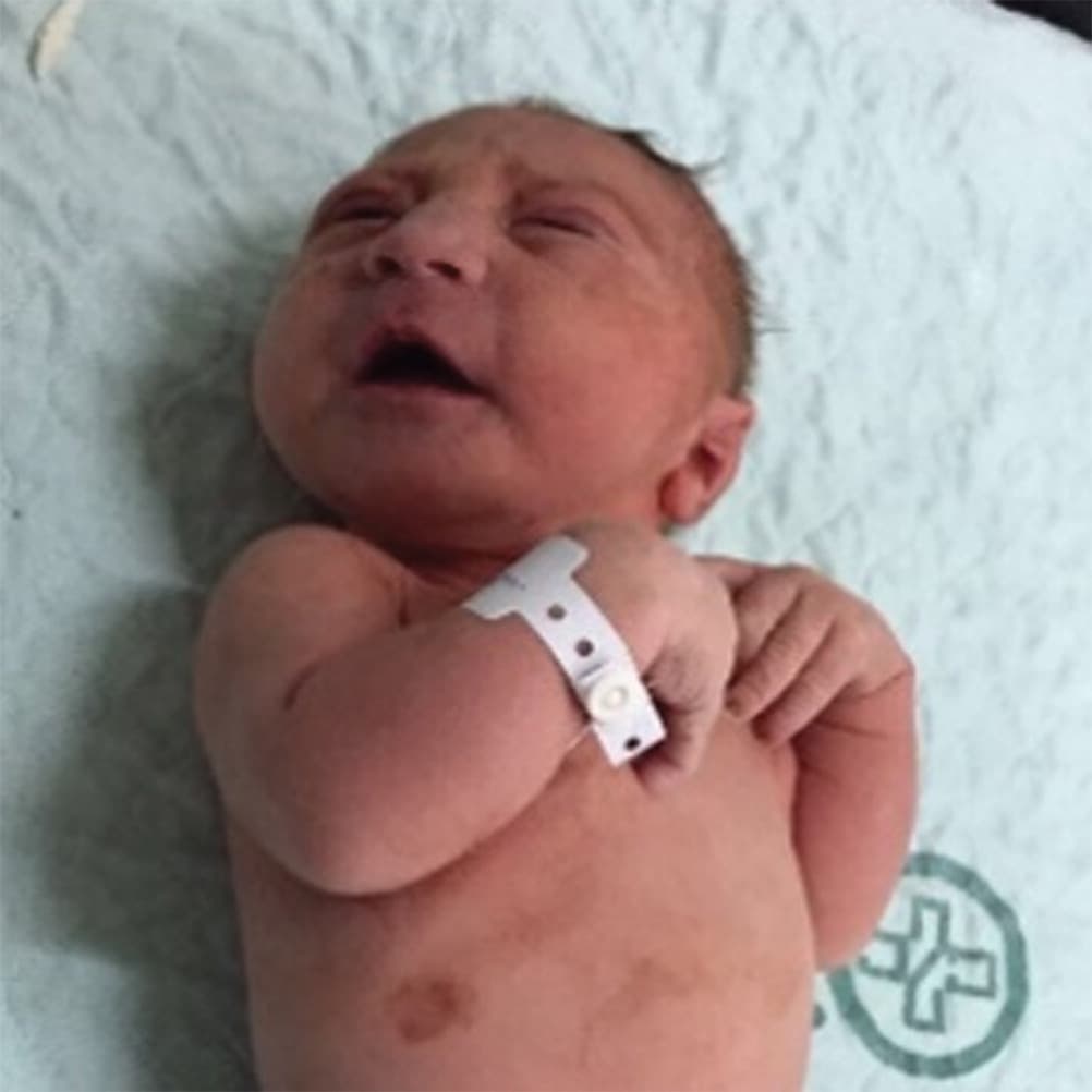 Su madre, de 34 años de edad, tuvo una erupción en la octava semana del embarazo.